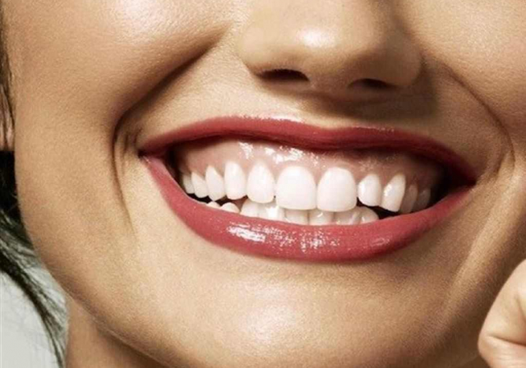 بوتاکس لبخند لثه ای