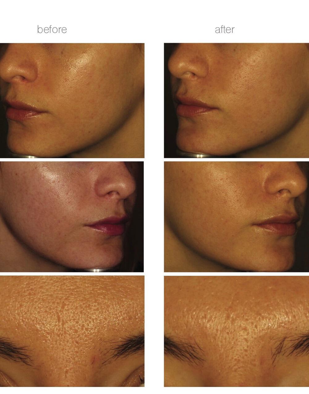 نتایج درمان جای جوش با RF Fractional Scarlet