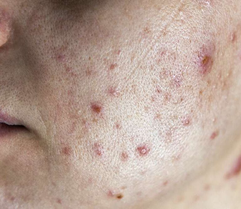 عوارض عدم پاکسازی پوست