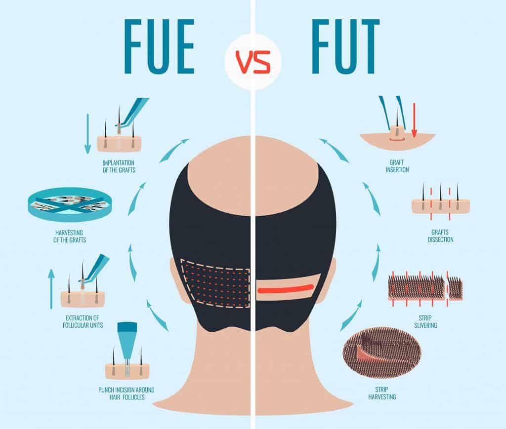 کاشت مو به روش FUE و FUT