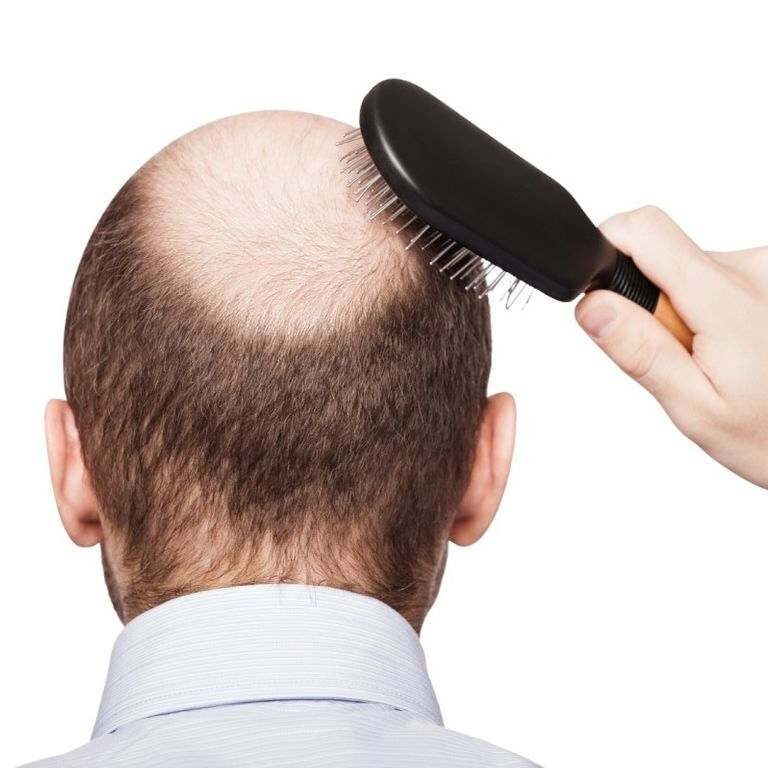 درمان ریزش مو