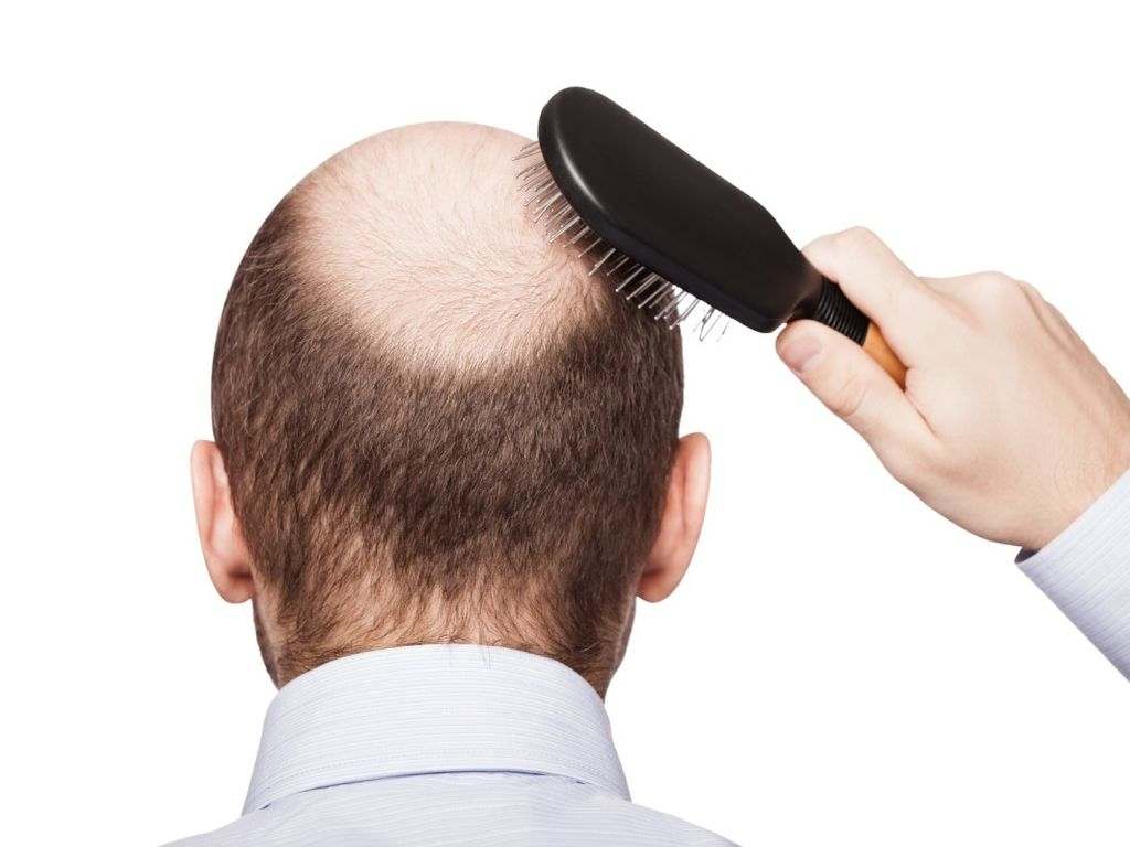 درمان ریزش مو