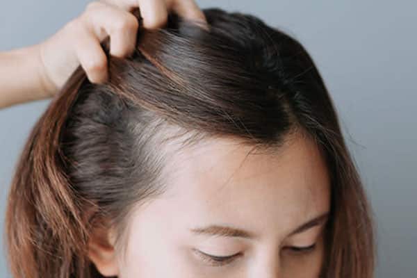 درمان ریزش مو زنان
