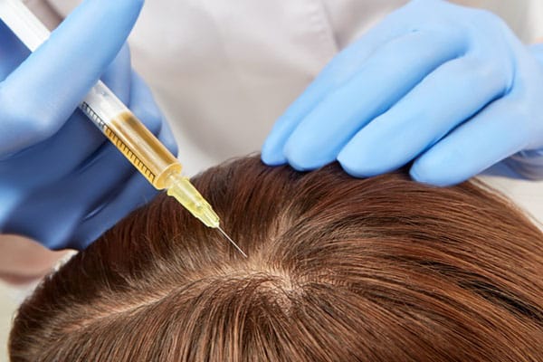 پلاسموتراپی غنی از پلاکت برای درمان ریزش مو (PRP)
