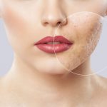 روش های درمان اسکار آکنه صورت - از بین بردن جای جوش صورت