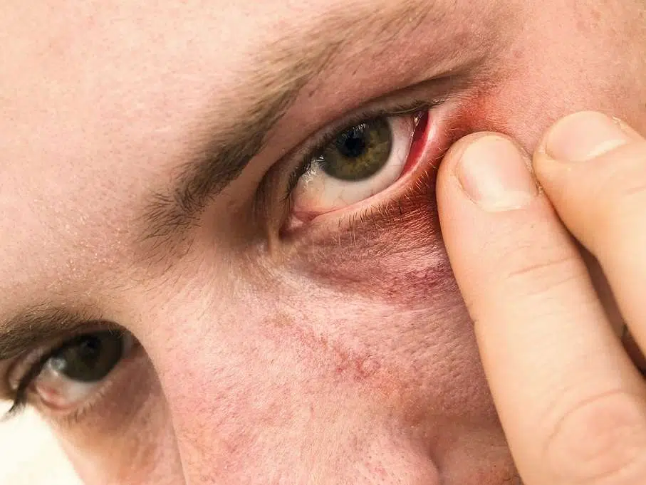 روزاسه چشمی