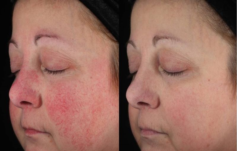 Rosacea درمان رزاسه با لیزر