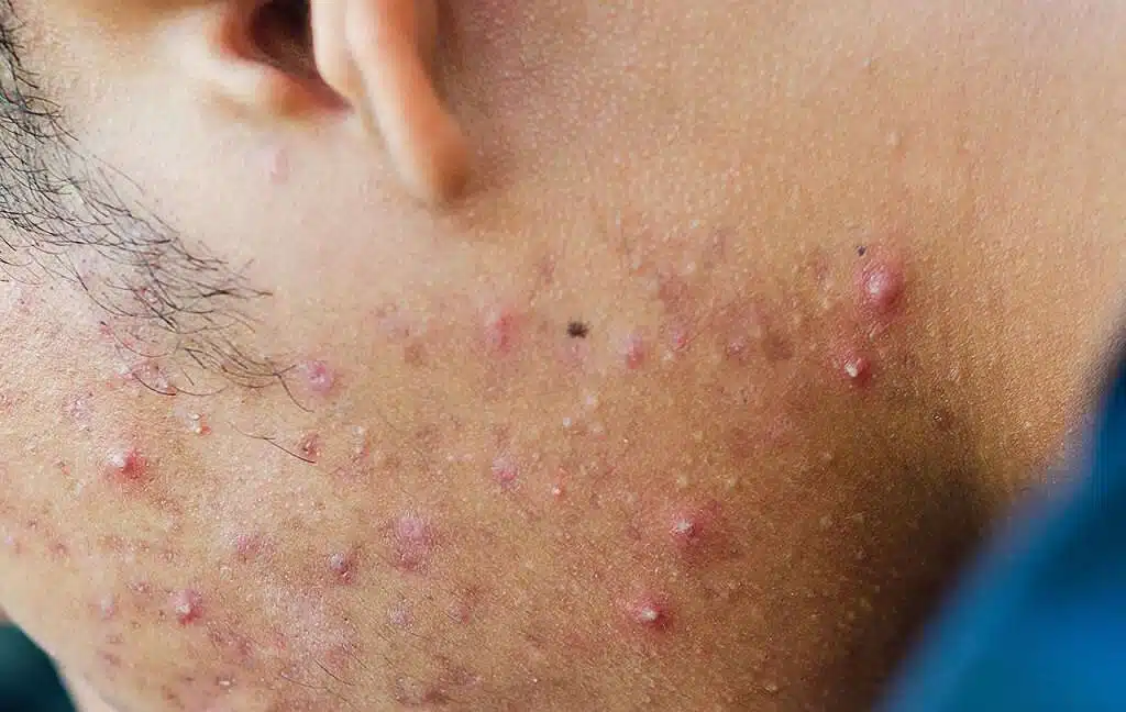 علل آکنه