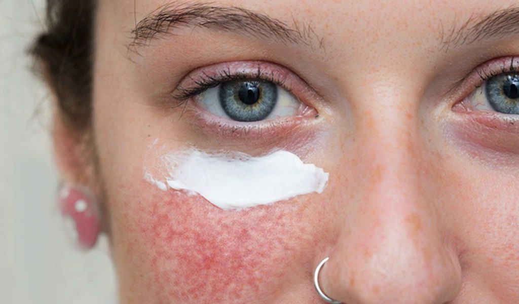 درمان قطعی روزاسه