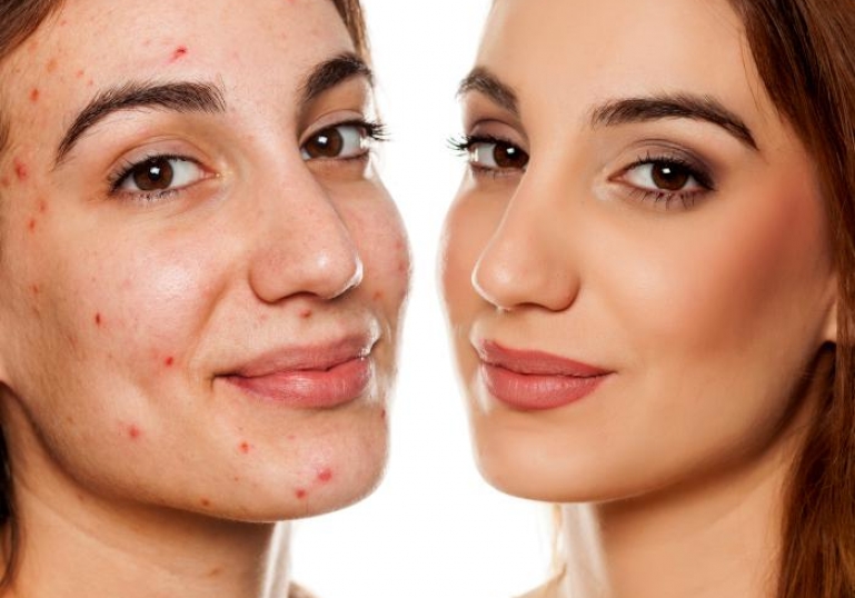آنتی بیوتیک برای جوش زیر پوستی