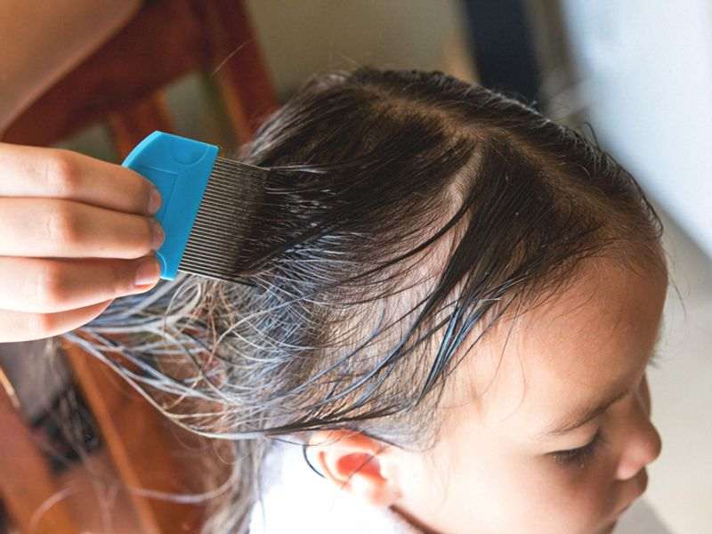 Head_lice_diagnose تشخیص شپش سر