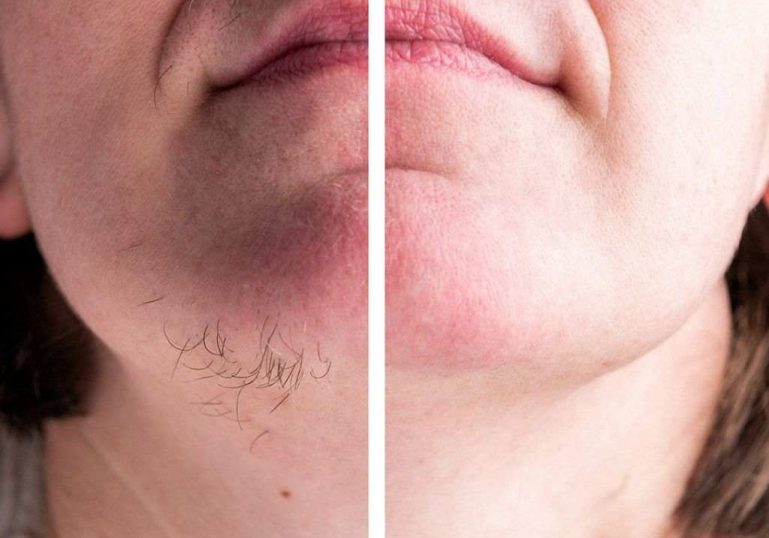 بیماری های موهای زائد