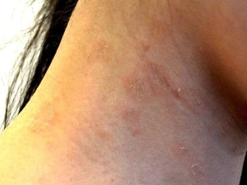 تشخیص پیتریازیس روزهآ