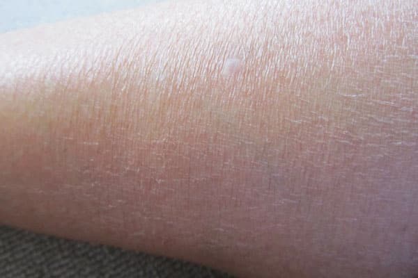 علت خشکی پوست ساق پا