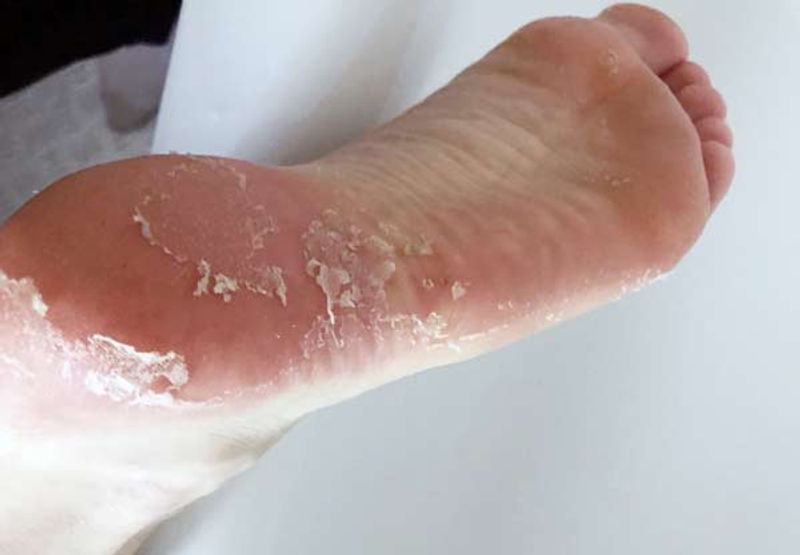 پوست پوست شدن کف پا