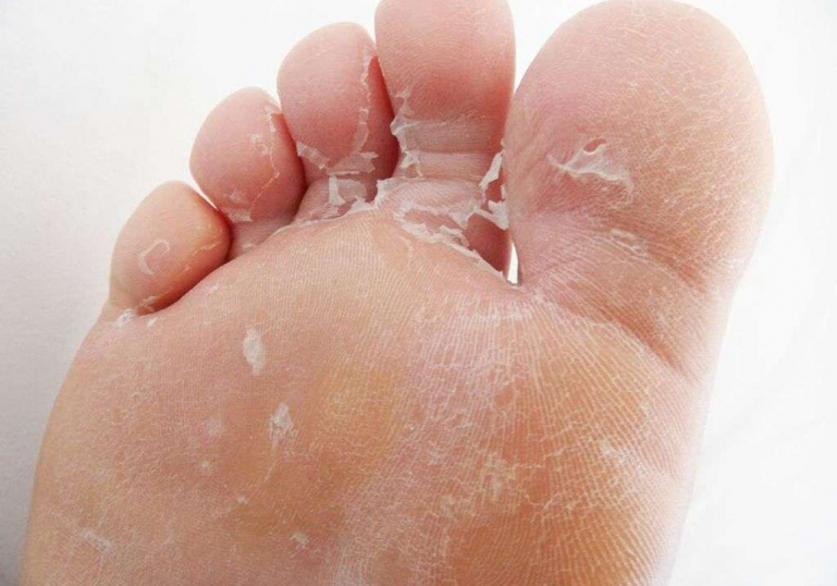 علت پوسته شدن کف پا