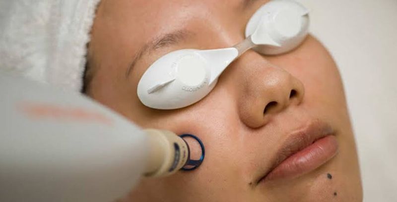 درمان لک صورت با لیزر