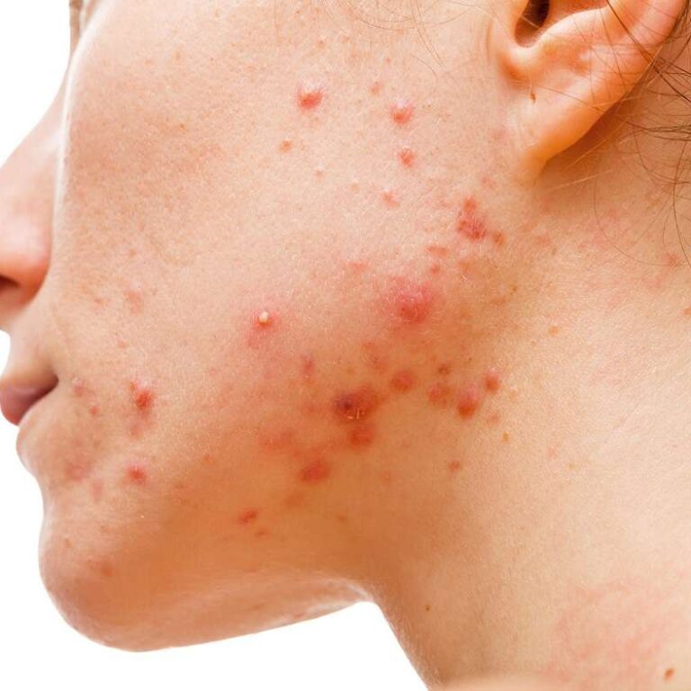 علت جوش زدن صورت در سن ۳۵ سالگی