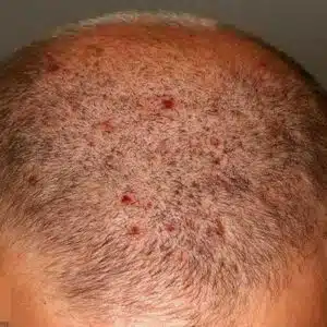 عکس فولیکولیت مو