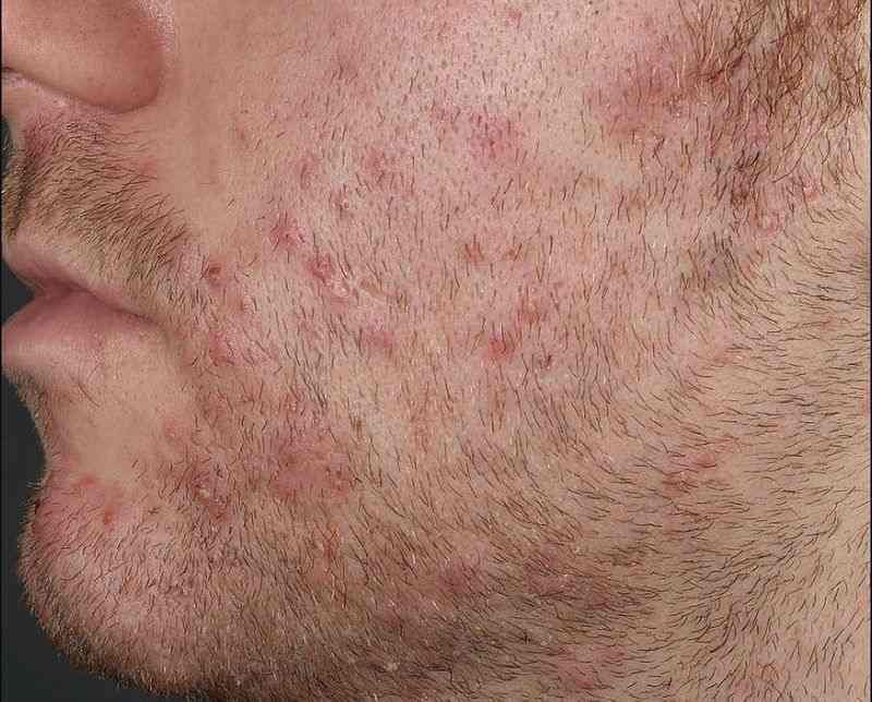 فولیکولیت ناشی از رشد مجدد موها