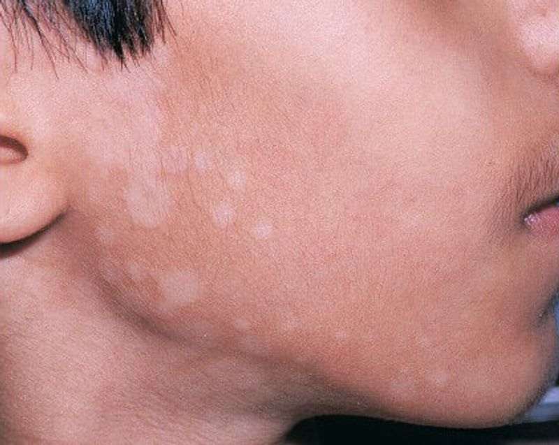 علائم و نشانه های تینه آ ورسیکالر