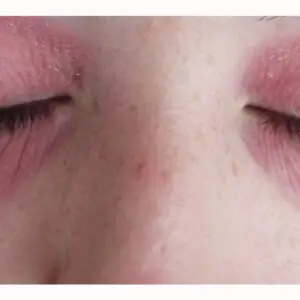 حساسیت به کرم دور چشم