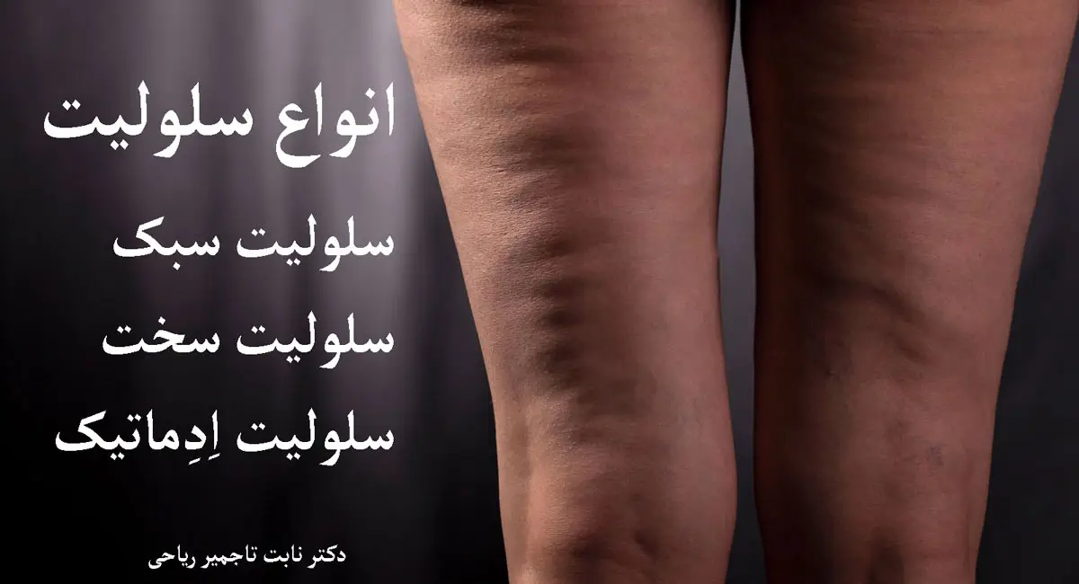 انواع سلولیت