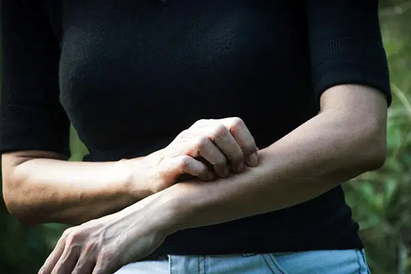 بیمار مبتلا به زونا