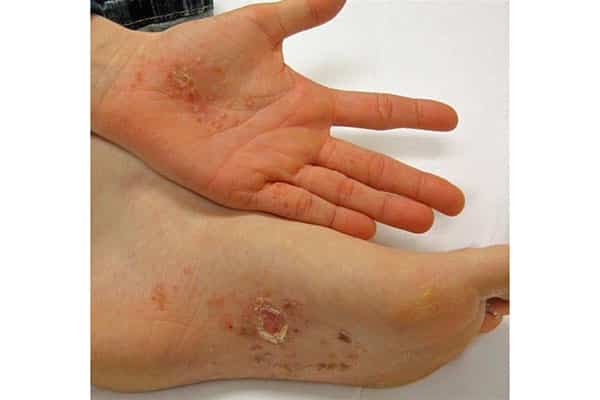 اگزمای دیشیدروتیک