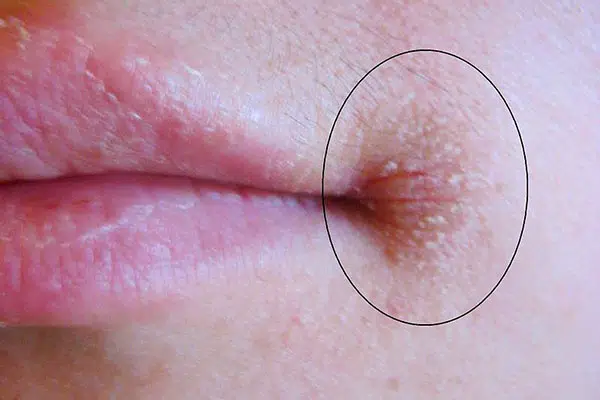 خشکی گوشه لب