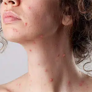 زونا تا چند روز قابل سرایت است