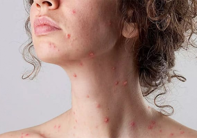 زونا تا چند روز قابل سرایت است