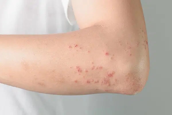 علائم زونا چیست