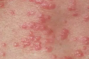 عکس بیماری گال