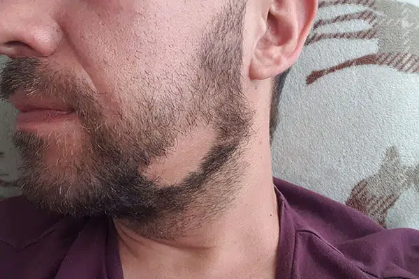 ریزش سکه ای ریش