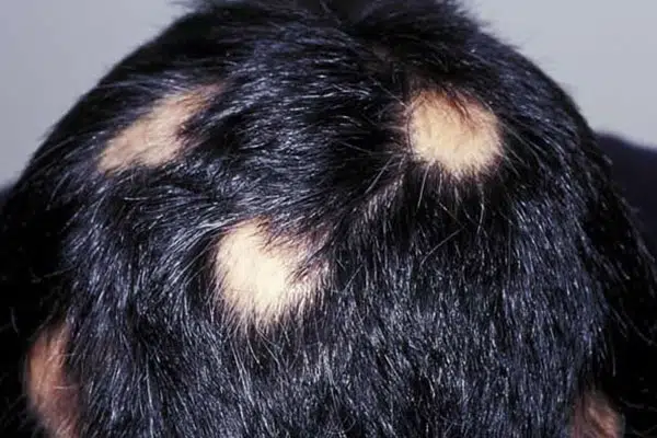 ریزش سکه ای مو