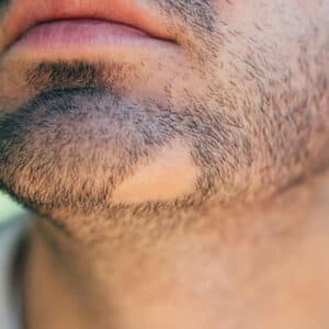 درمان ریزش سکه ای ریش