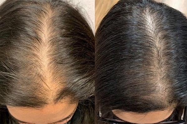 آمپول ضد ریزش مو