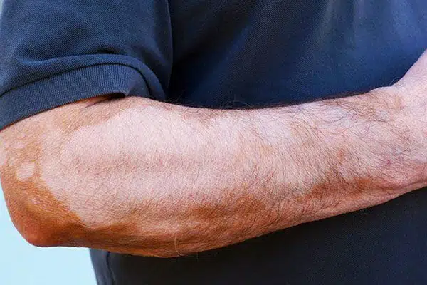 درمان قارچ بدن