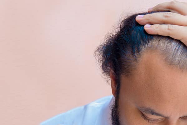 علائم اولیه ریزش مو بعد از کرونا
