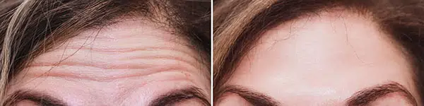 تزریق بوتاکس برای پیشانی