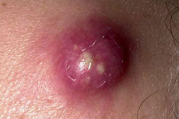 عکس دمل چرکی