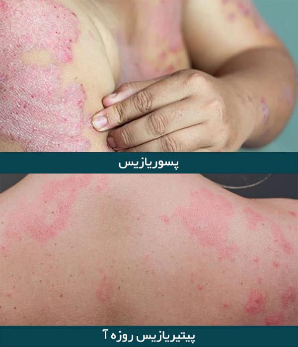 تفاوت پیتریازیس و پسوریازیس