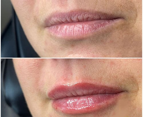 جوانسازی لب