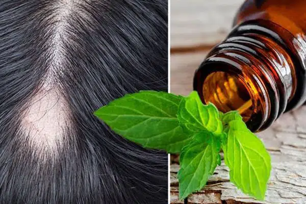 روغن نعناع و رزماری برای ریزش موی هورمونی