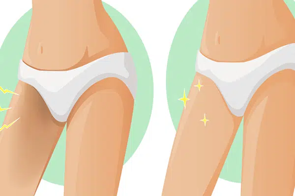 روش های رفع تیرگی کشاله ران