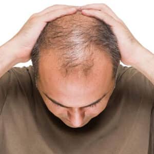 چگونه از ریزش مو ارثی جلوگیری کنیم
