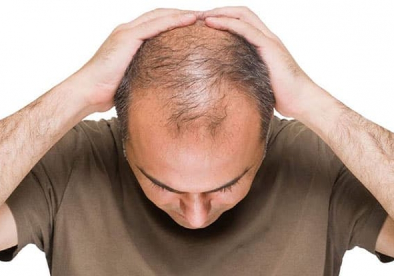 چگونه از ریزش مو ارثی جلوگیری کنیم