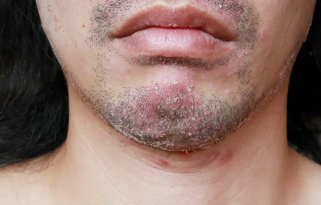 انواع پسوریازیس با عکس