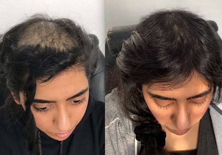 عکس قبل و بعد از پی آر پی